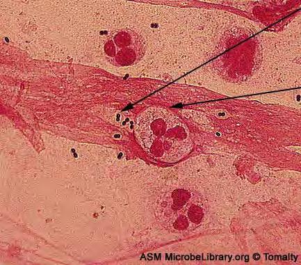 Capsula Diplococchi Gram positivi capsulati leucocita polimorfonucleato