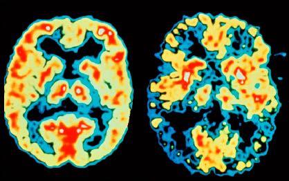 Quando il cervello si inceppa COLLEGAMENTO salute Morbo di Alzheimer Forma di deterioramento mentale o