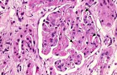 Microangiopatia Trombotica (TMA) Fibrin stain.