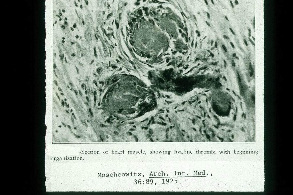 Autopsy showed hyaline thrombi