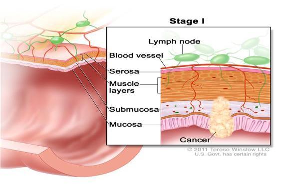 Faza 2 Tumori është zgjeruar edhe më thellë në ose përmes murit të kolonit