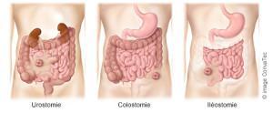 GESTIRE UNA «STOMIA INTESTINALE» CLASSIFICAZIONE IN BASE ALLA SEDE ANATOMICA ileostomia; ciecostomia; colostomia destra; trasversostomia; colostomia sinistra; sigmoidostomia.