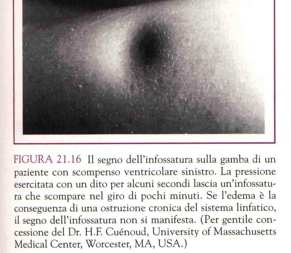 V sinistro edema polmonare scompenso cardiaco V destro edema in tutto il corpo esclusi polmoni scompenso bilaterale cronico (insufficienza cardiaca congestizia) edema sistemico L'edema (gonfiore) è