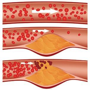 Aterosclerosi L aterosclerosi costituisce una delle concause delle malattie cardio-vascolari, quali infarto al miocardio, angina, ictus cerebrale.