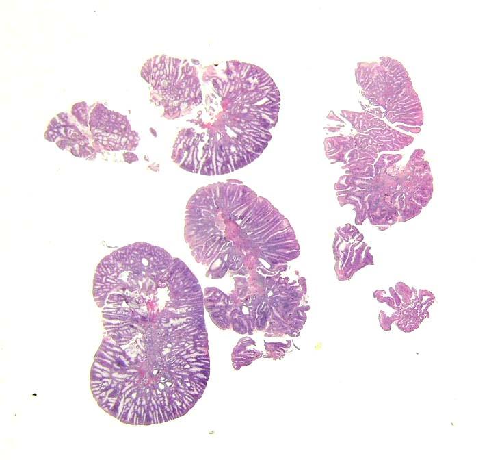 Il risultato alle volte L endoscopista o il patologo?