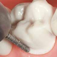 1 2 3 4 5 6 Corona per denti posteriori completamente in ceramica* 1. Realizzare un gradino uniforme, largo 1 mm, ca.