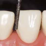 1 2 3 4 5 6 Corona per denti frontali completamente in ceramica* 1.