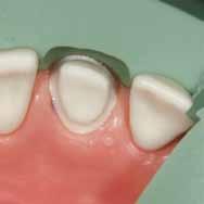 In fase di utilizzo del diametro grande (021) assicurarsi che i denti vicini non vengano danneggiati. 8.