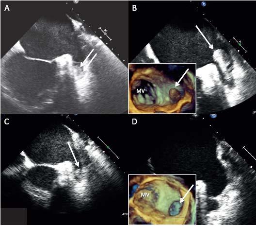 First presentation During VKA therapy After 4 weeks of