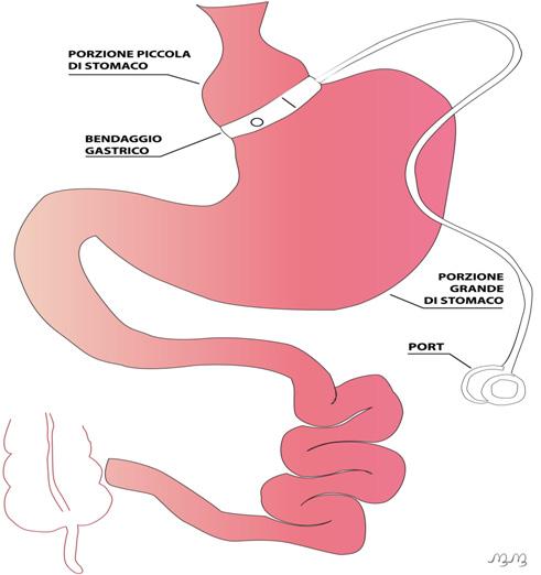 BENDAGGIO GASTRICO Descrizione La tasca gastrica viene creata strozzando la parte superiore dello stomaco con un anello di silicone.
