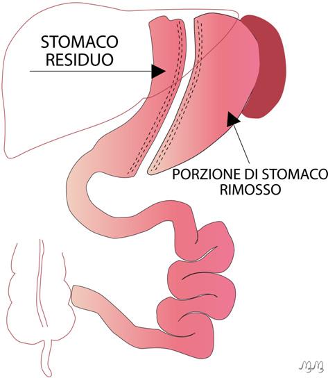 SLEEVE GASTRECTOMY Descrizione A differenza del bendaggio, questo intervento prevede l asportazione di gran parte (2/3) di stomaco sezionata verticalmente.