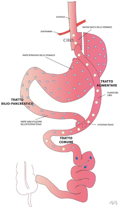 BY-PASS GASTRICO Descrizione In questo intervento viene creata una tasca gastrica non collegata al resto dello stomaco ma direttamente all intestino.