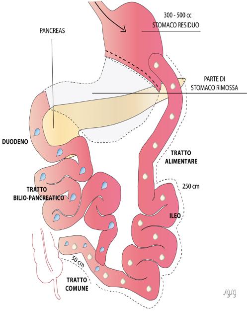 DIVERSIONE BILIO-PANCREATICA Descrizione Esistono diverse varianti dell intervento e la più utilizzata è la variante secondo Scopinaro.