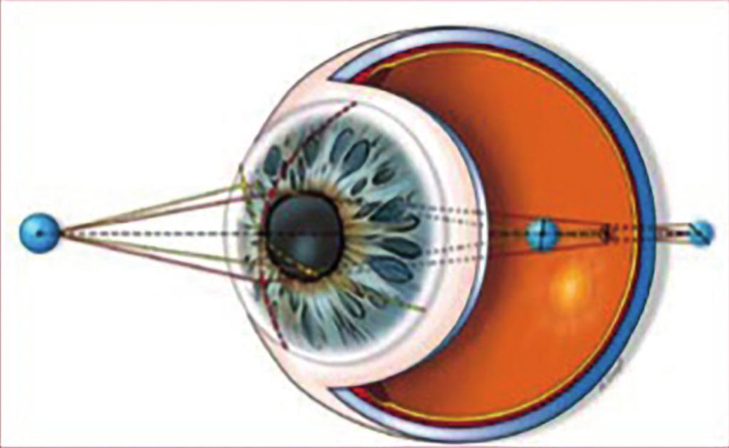 ASTIGMATISMO L astigmatismo è un difetto visivo prodotto dalla cornea che non mantiene un piano di uniformità ottica su tutta la sua superficie.