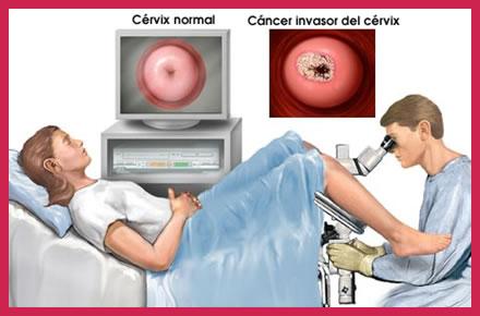 La colposcopia Indagine diagnostica di II livello che consiste nel visionare a forte ingrandimento i genitali femminili (vulva, perineo, vagina, cervice uterina) servendosi di un particolare