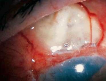SINS (Surgically Induced Necrotising Scleritis) Esordio entro 3 settimane da un trauma chirurgico: cataratta chirurgia retinica e del glaucoma