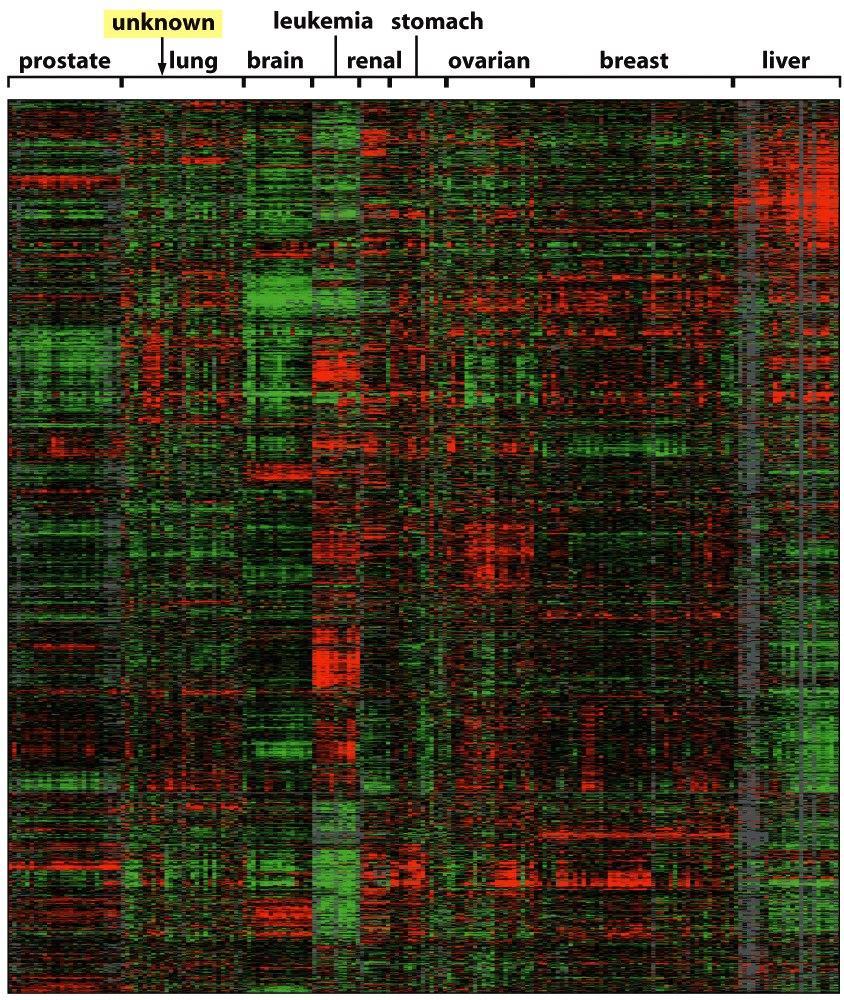 Determinazione dell espressione di 1800 geni differenti in vari tipi di cancro