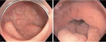 meet the expert A - Visione in aria B - Visione in acqua C - Marcatura con sonda APC D - Cattura della lesione E - Chiusura dell'ansa F - Cattura di adenoma residuo G - Visione in aria dopo resezione