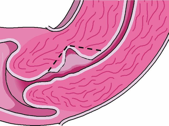 ISTMOCELE Istmocele: diverticolo della parete anteriore in corrispondenza del terzo superiore del canale cervicale al confine con l istmo o dell istmo stesso, all interno del quale è possibile