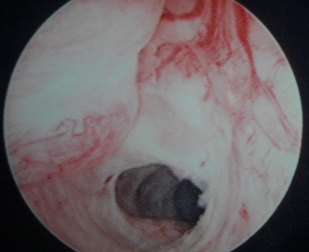 interno della fovea con sua successiva emissione, preceduta e/o accompagnata da dolore La prominenza della cicatrice isterotomica