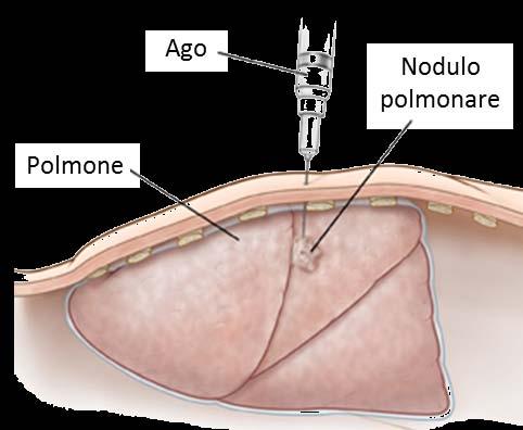 Cos è la biopsia tradizionale e a cosa serve? La biopsia rappresenta una procedura essenziale per la diagnosi di tumore.