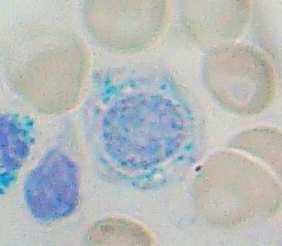 ANEMIA: 1) Da difetti maturativi: a) Ferrocarenziali Neonatale: - Difetto di apporto da protratta lattazione - Pretermine - Emorragie neonatali / emolisi - Carenze marziali materne Adulto: - Eccesso