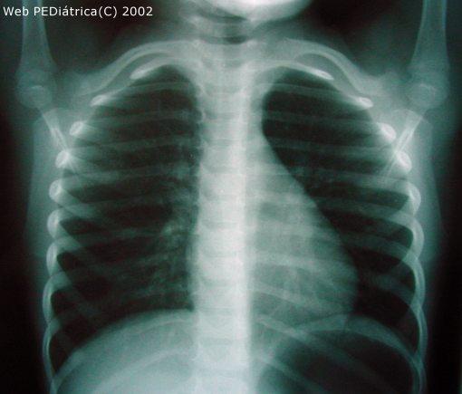 La scarsa attenuazione del fascio di Raggi X (per attraversamento ad esempio dei tessuti polmonari) si traduce in un forte annerimento del radiogramma.