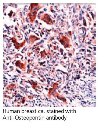 OSTEOPONTINA è una fosfoglicoproteina prodotta da diversi tipi cellulari (osteoblasti, macrofagi, cellule dendritiche, cellule epiteliali, linfociti T) Aumentata nelle patologie infiammatorie,