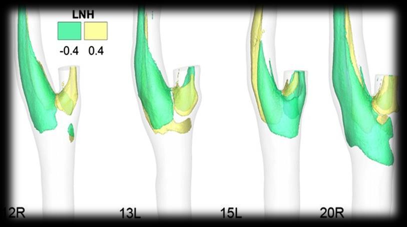 Lee Anno pubblicazione: 2008 Considerazioni fluidodinamiche: Helical flow in carotid bifurcation as surrogate