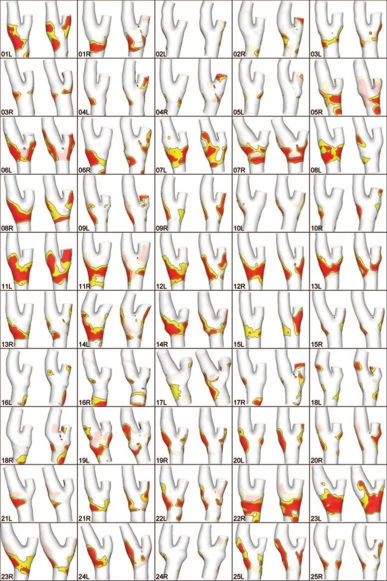 Geometry of the Carotid Bifurcation Predicts Its Exposure to Disturbed Flow (Lee-2008) Risultati Nella maggior parte dei casi il flusso disturbato si trova vicino alla biforcazione o nelle pareti