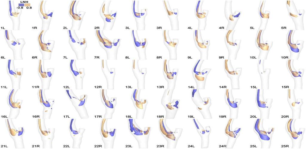 Helical flow in carotid bifurcation as surrogate marker of exposure to disturbed shear (Gallo-2012) Risultati Distribuzione LNH più elicoidale nelle carotidi di destra meno nelle carotidi di sinistra