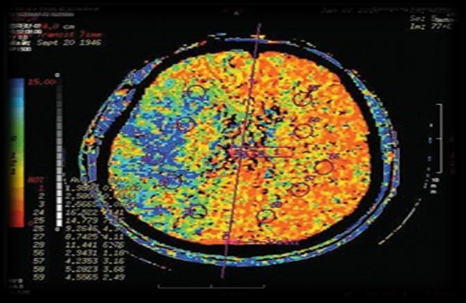 Studio prospettico a sostengo dello stenting* Obiettivo Impianto stent carotideo Miglioramento della perfusione