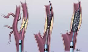 Trattamento endovascolare e non Endoarteriectomia Rimozione chirurgica del materiale che