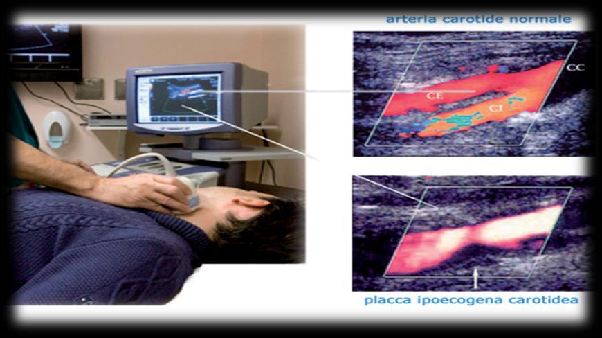 Stenosi: diagnosi e classificazione Conferenza di consenso San Francisco,Ottobre 2002* Convocata dalla Società dei Radiologi al fine di elaborare raccomandazioni per diagnosticare e classificare la