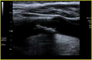 Esame eco-color-doppler ECOGRAFIA VASCOLARE (B Mode) Scansioni Longitudinali (AL-L-PL), Trasversali (AL-L-PL):