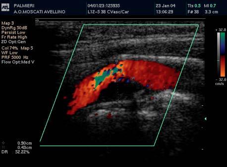 sistolico carotide interna Sede stenotica/picco sistolico della