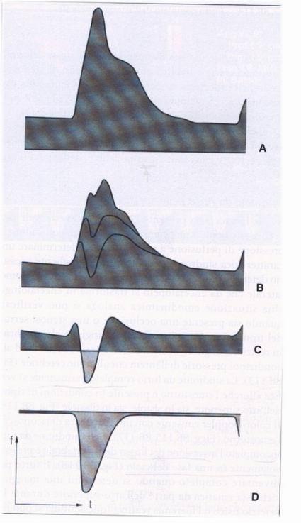 La diagnostica del distretto succlavio-vertebrale FURTO DELLA SUCCLAVIA Stenosi <45% Stenosi 55% Pre-furto o furto latente Stenosi 80% furto incompleto o intermittente Stenosi serrata