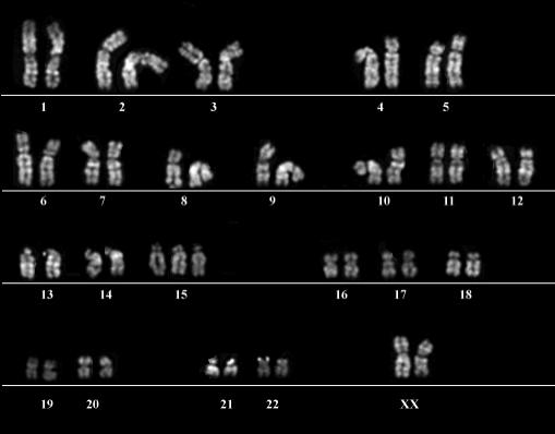 Trisomia nell uomo 47XX+15 trisomia del cromosoma 15 Incompatibile con