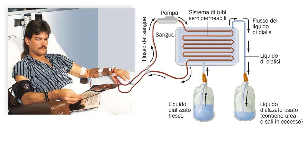 Il rene artificiale ripulisce il sangue dall urea e dall eccesso di sali I pazienti con insufficienza renale devono essere sottoposti a