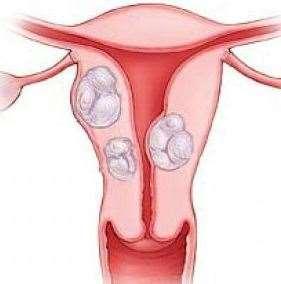 LNG-IUD non ha effetto sul volume dei fibromi uterini 1.