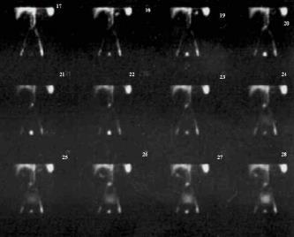 Arteriografia  La freccia indica