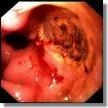 Neoplasie Dieulafoy