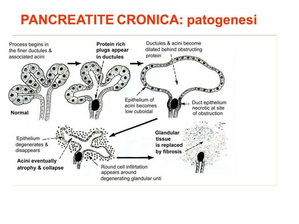 Pancreatite cronica: fisiopatologia Ductal obstruction hypothesis. L abuso cronico di alcol porta alla secrezione di un succo pancreatico ricco in proteine, denso e povero in bicarbonati.