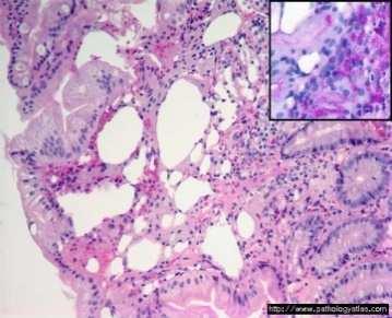 propria and other causes: - Parasites (Giardia, Criptosporidia, Cyclospora) - Ischemia /