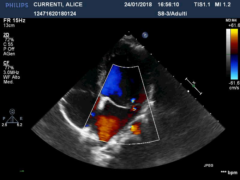 Insufficienza mitralica Lieve se : - morfologia del jet sfumato paraboloide - piccolo centrale al color doppler - vena contratta <3mm - area orifizio rigurgitante ERO < 20 mm2 - volume rigurgitante <