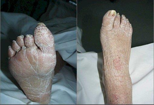 secchezza (anidrosi) della pelle del piede dovuta al malfunzionamento delle