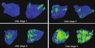 Atrial fibrosis helps select the