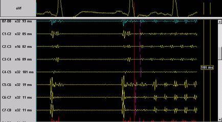 pulmonary veins PV LA