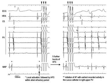 Intrinsic cardiac autonomic stimulation induces PV