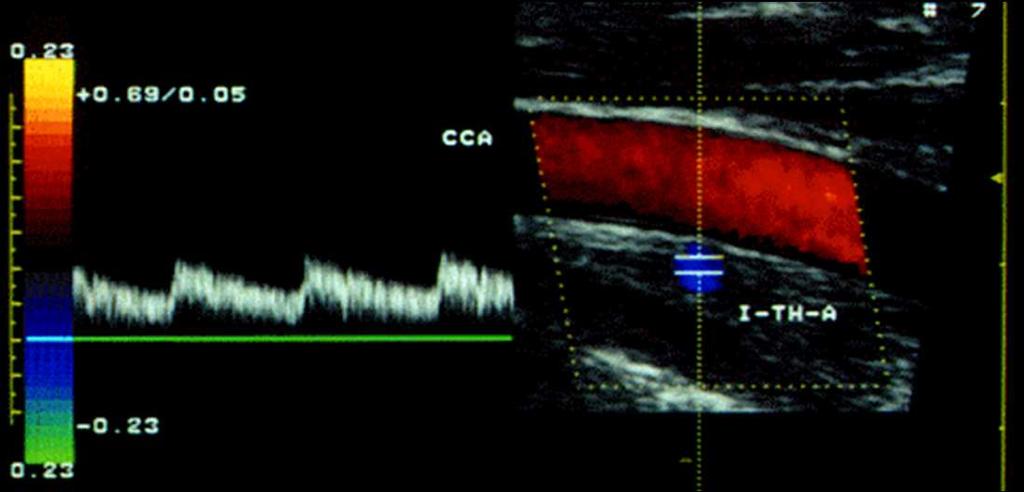 Color Doppler È possibile dirigere il campionamento con Doppler spettrale (comunque